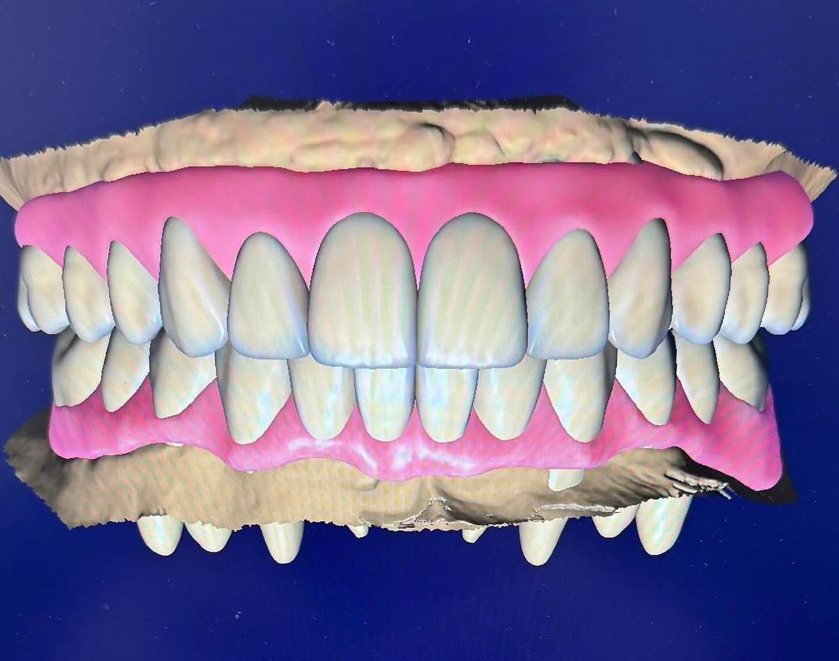 Full arch smile design