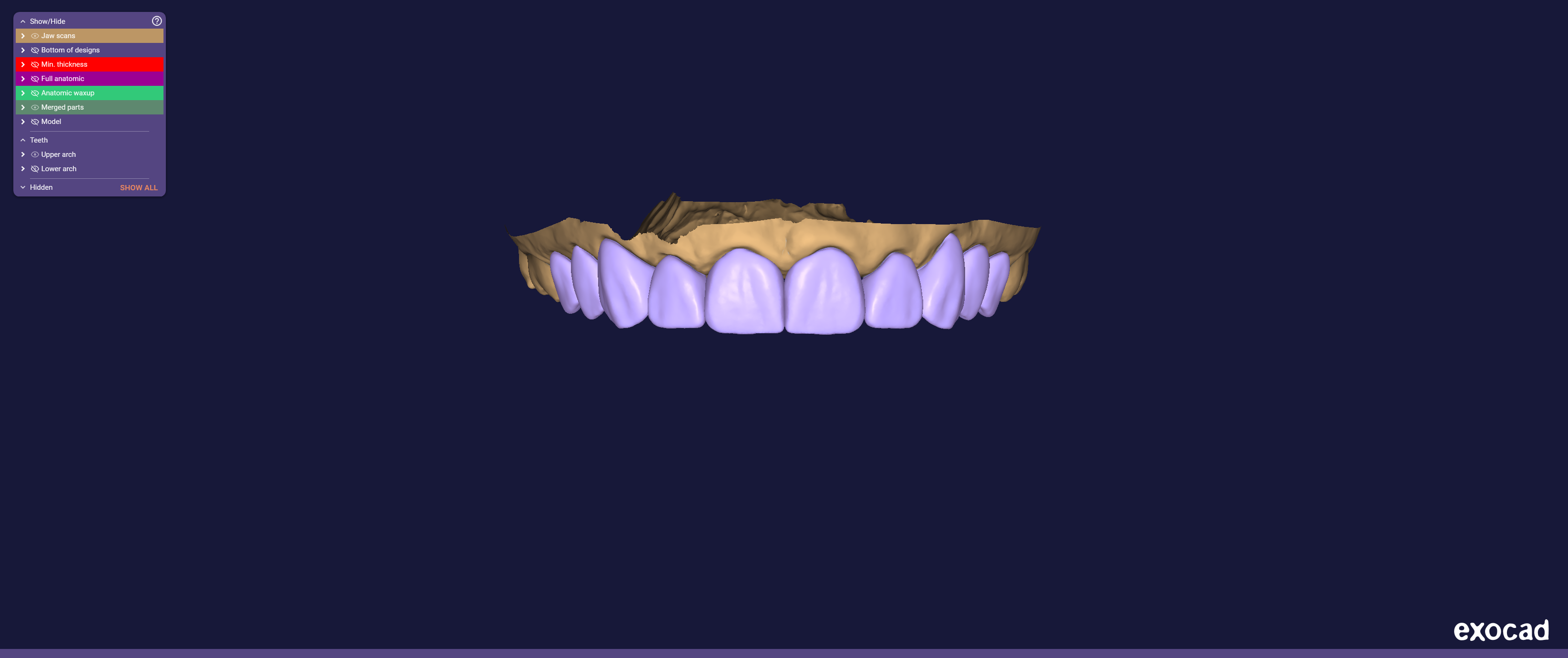 Exocad anterior esthetic dental design case