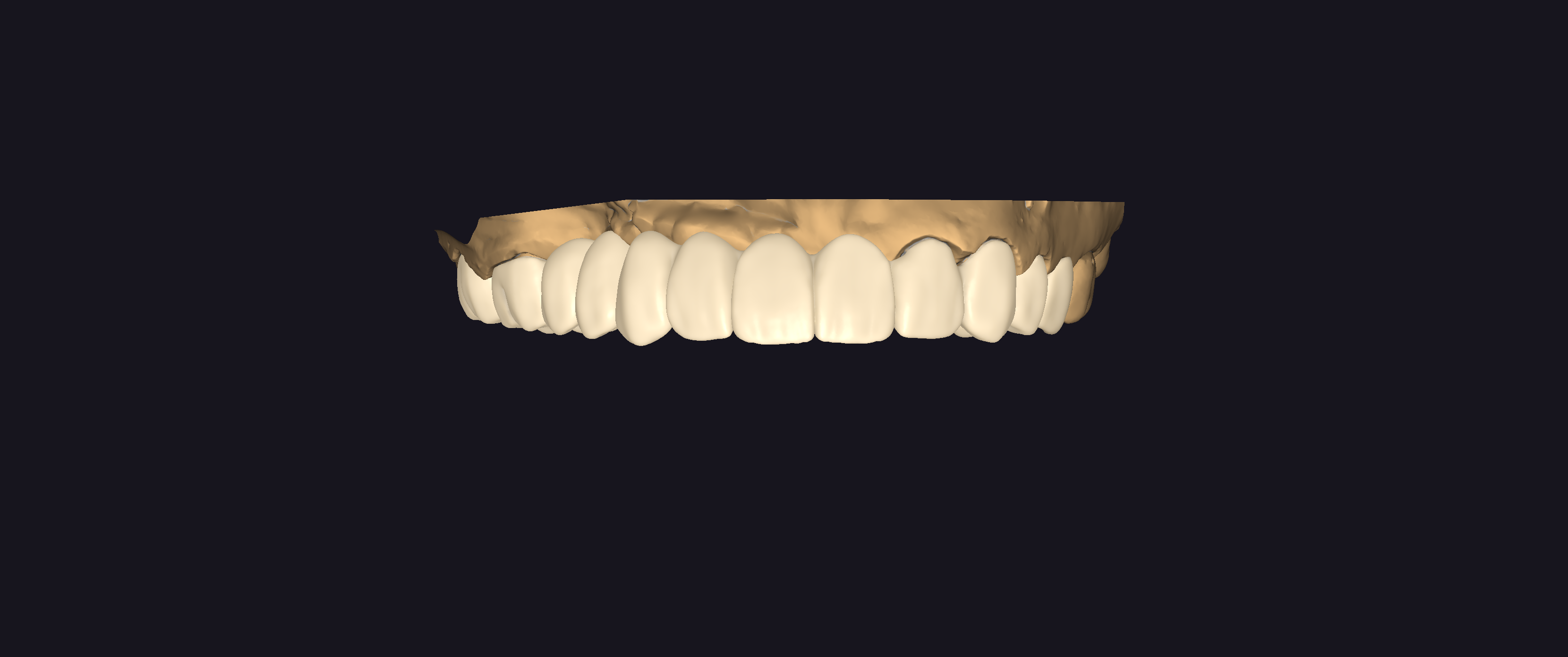Digital restorative anterior dental CAD case